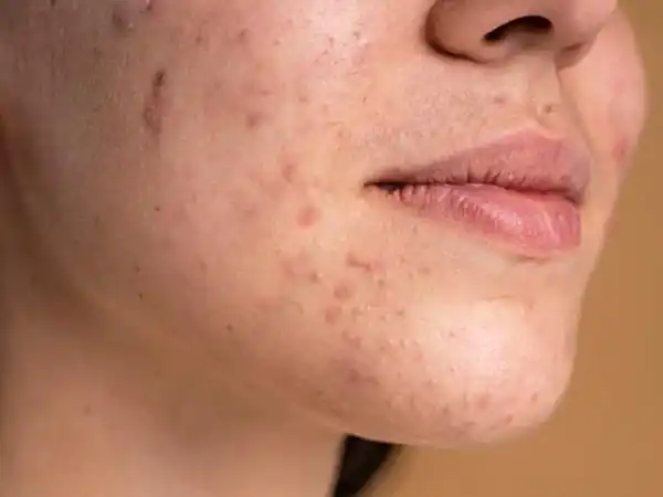 Akne Skarı (İzleri)