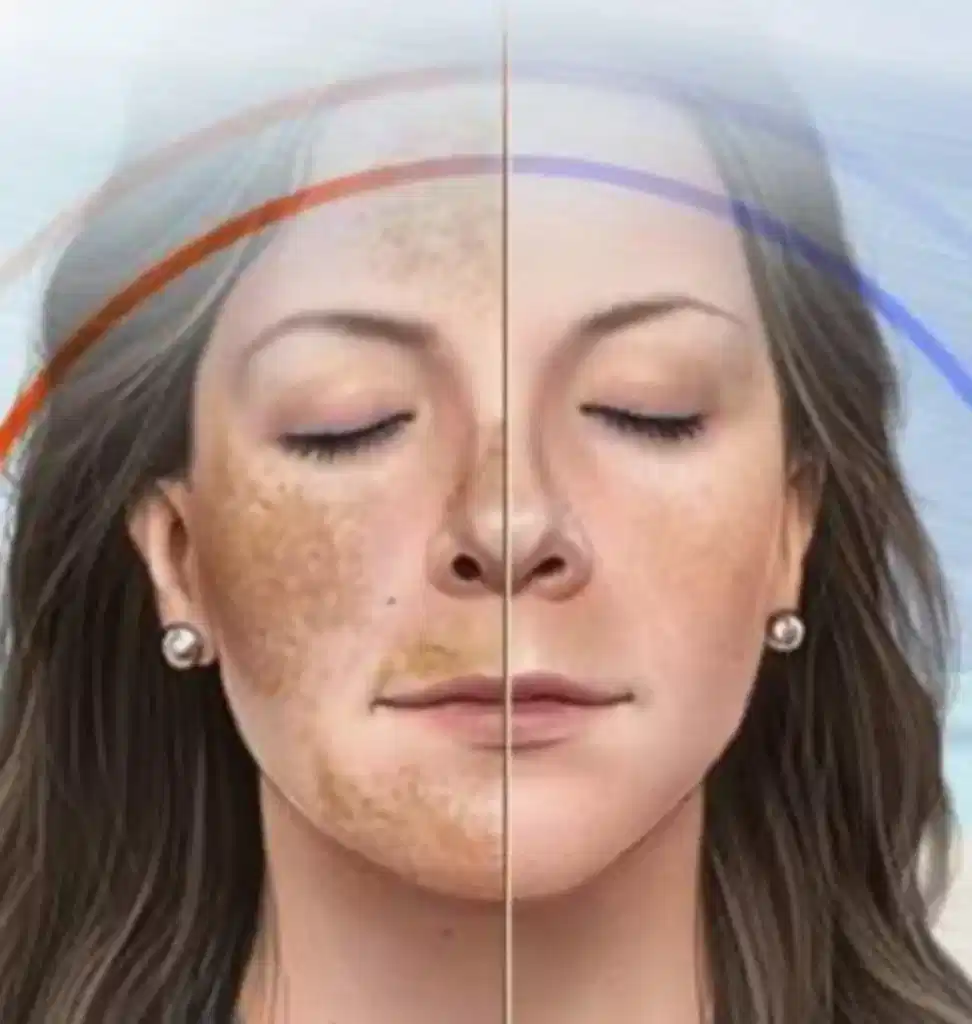 Lekeler ve Tedavileri