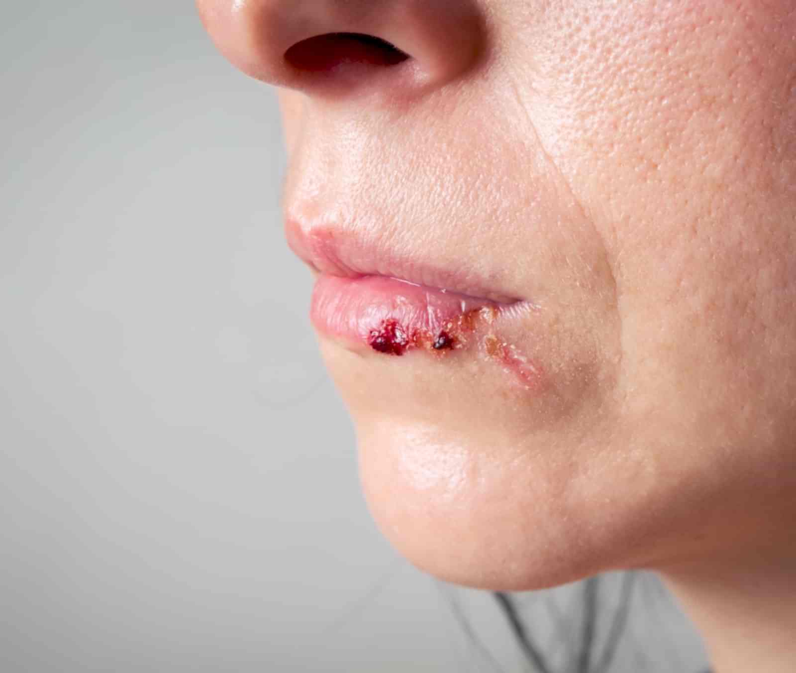 Uçuk Tedavisi Ankara