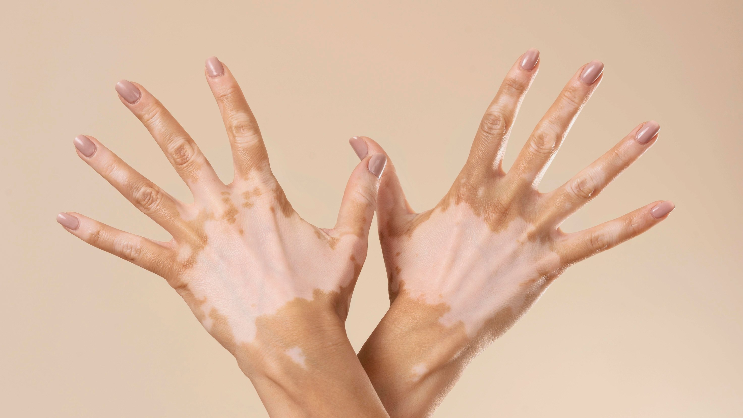 Vitiligo Tedavisi Ankara